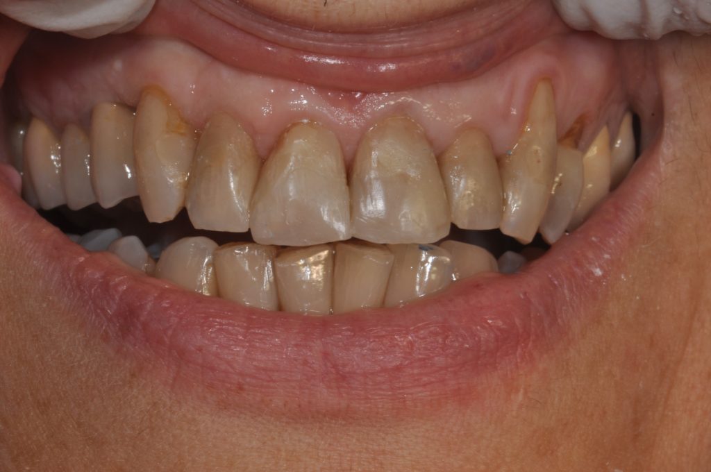 gengive e denti prima con parodontite