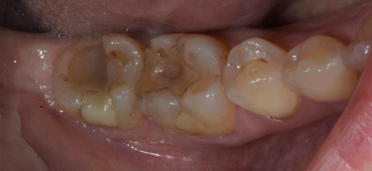 denti prima del trattamento consevativo