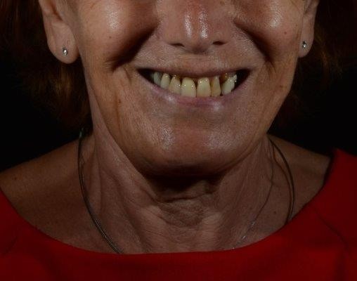 denti prima del trattamento impianti dentali