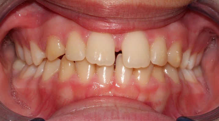 trattamento ortodonzia busto arsizio prima