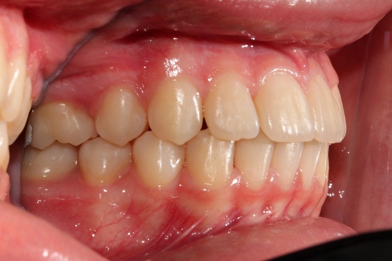 denti dopo ortodonzia a busto arsizio
