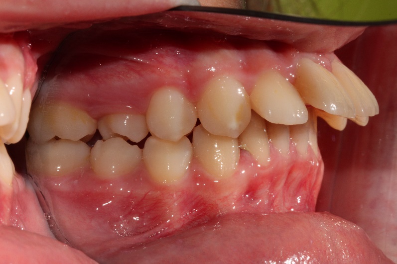 denti prima ortodonzia a busto arsizio