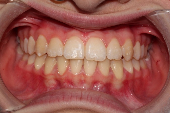 denti dopo il trattamento ortodontico a busto arsizio