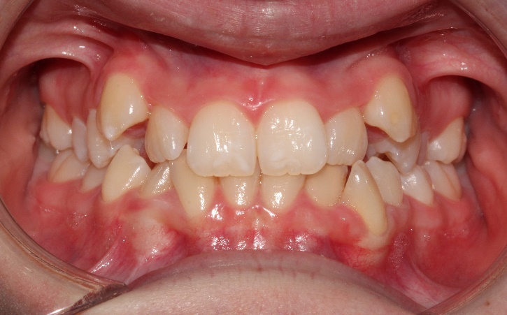 denti prima del trattamento ortodontico a busto arsizio