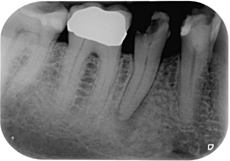 dente con granuloma