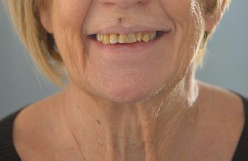denti prima del trattamento odontoiatrico nello studio dentistico olgiati a busto arsizio